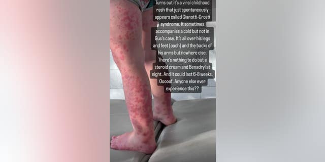 Mandy Moore showing photo of Gus’s legs covered in red patches